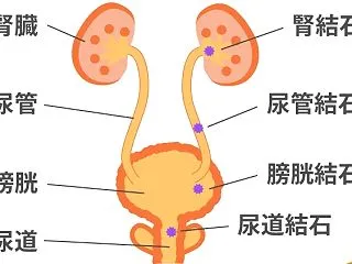 尿路結石