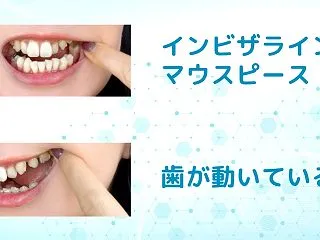 インビザライン マウスピース矯正30個目…