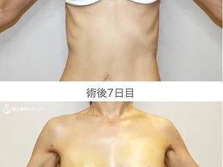 体重37kgで脂肪注入豊胸（7日目）
