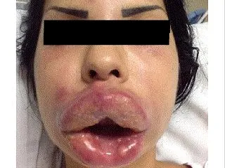 【翻訳まとめ】女性、セルフボトックスで地…