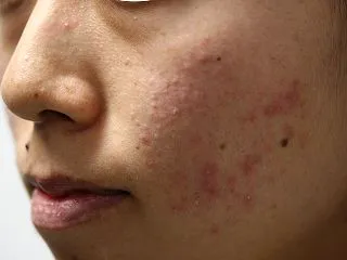 ニキビは、赤くなる前から始まっている！ …