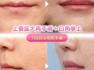 「上唇拡大を受けたのに、変化がないまま傷…