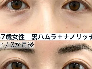 目の下のクマ取り/裏ハムラ法+ナノリッチ…
