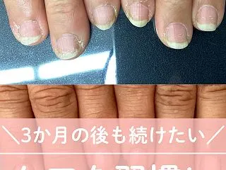 自爪育成3か月のあともケアを継続｜見附市…