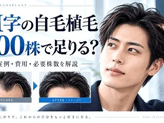 M字の自毛植毛は500株で足りる？症例・…