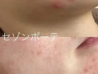 AHAツヤ肌ピーリング２回目