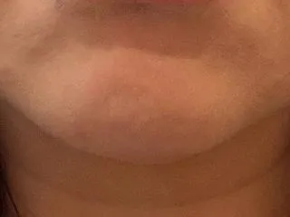 顔面課金HIFU