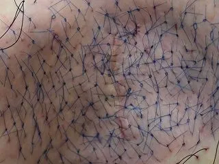 ワキガをきっちり治すために広く手術すると…