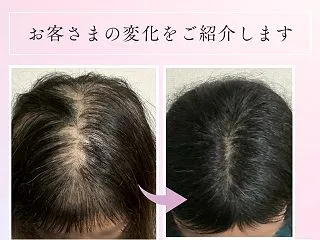 【お客様のビフォーアフター】可児市の薄毛…