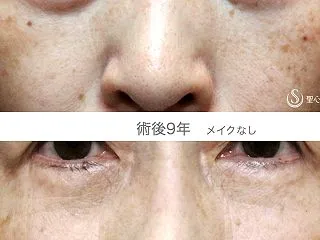表ハムラ+α法の長期経過（9年後）