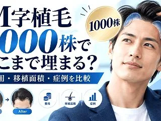 M字植毛1000株でどこまで埋まる？費用…